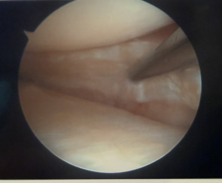 Arthroscopic view of a meniscal tear