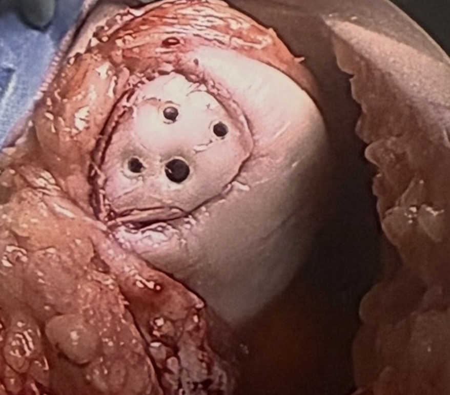 Osteochondral defect repair with fixation