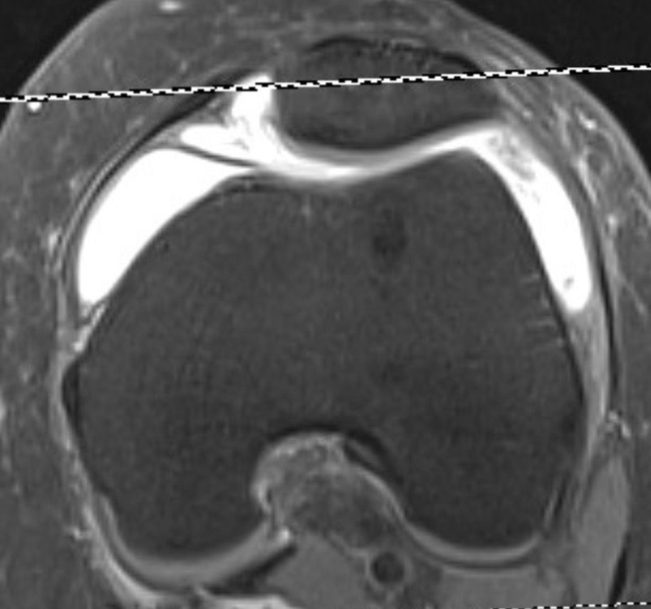 MRI scan showing a thickened medial plica in the knee joint