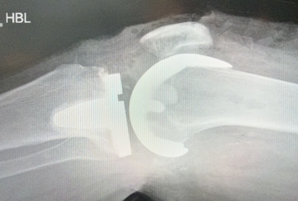X-ray of a total knee replacement (lateral view)