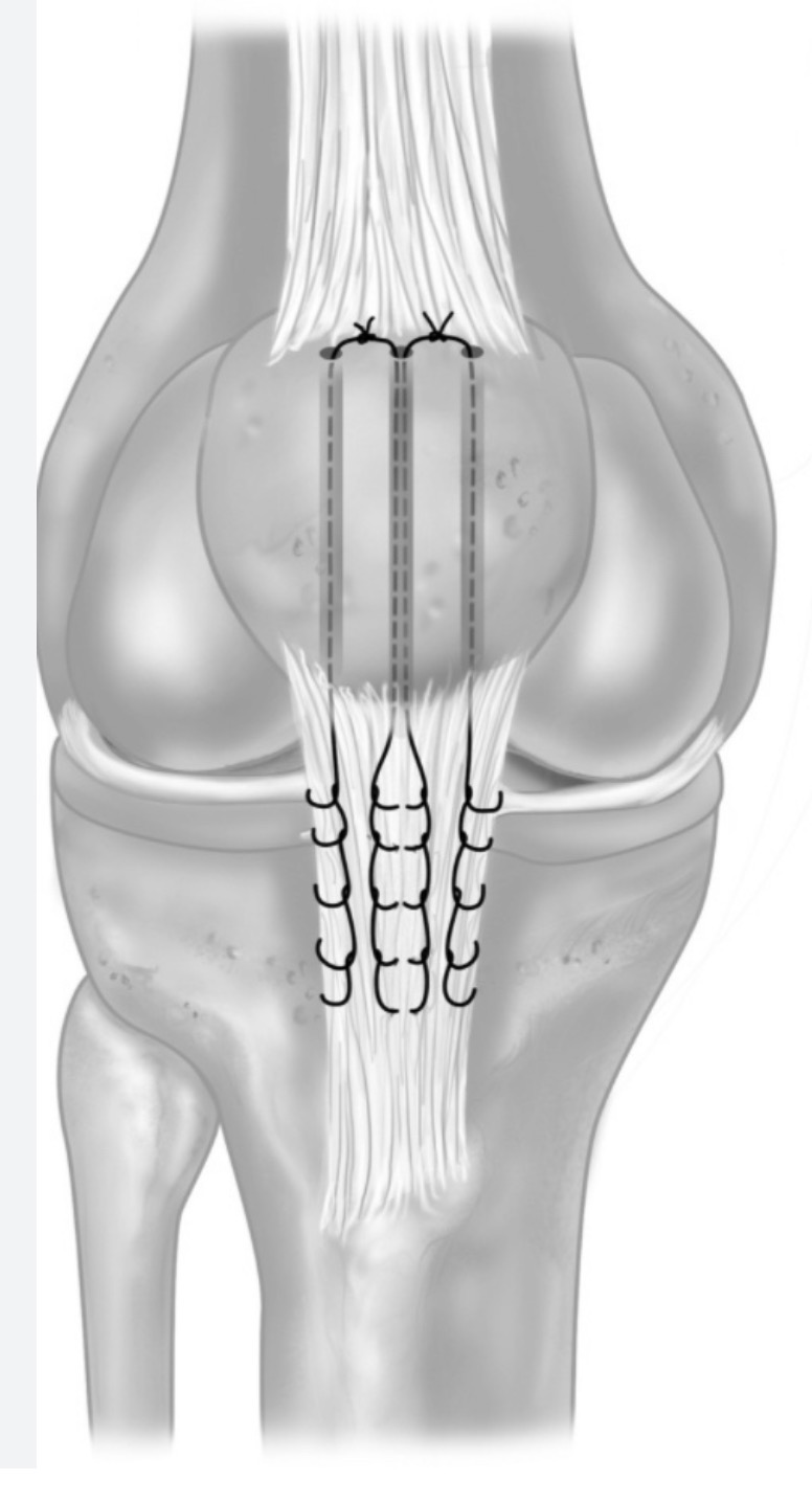 Surgical technique illustration showing suture repair of the patellar tendon