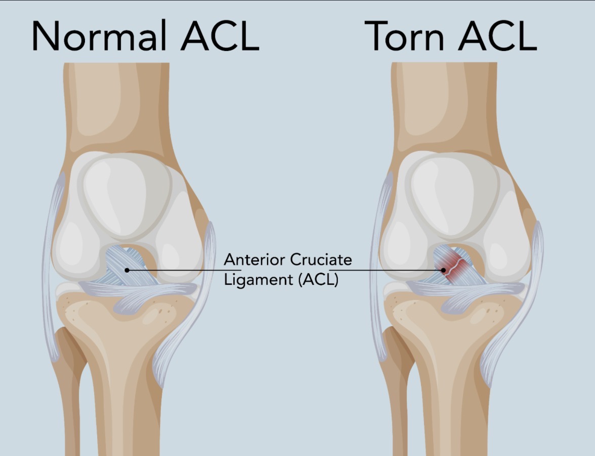 Diagram comparing a normal ACL to a torn ACL inside the knee joint