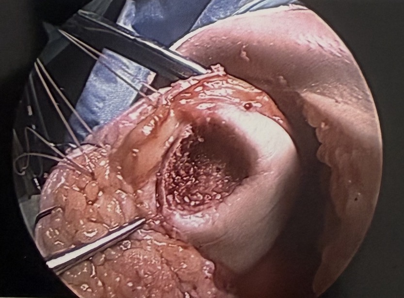 Surgical preparation of an osteochondral defect