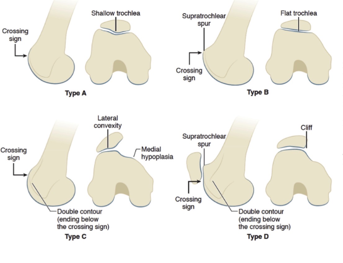 Diagram showing the four types of trochlear dysplasia (A, B, C and D) with associated anatomical features