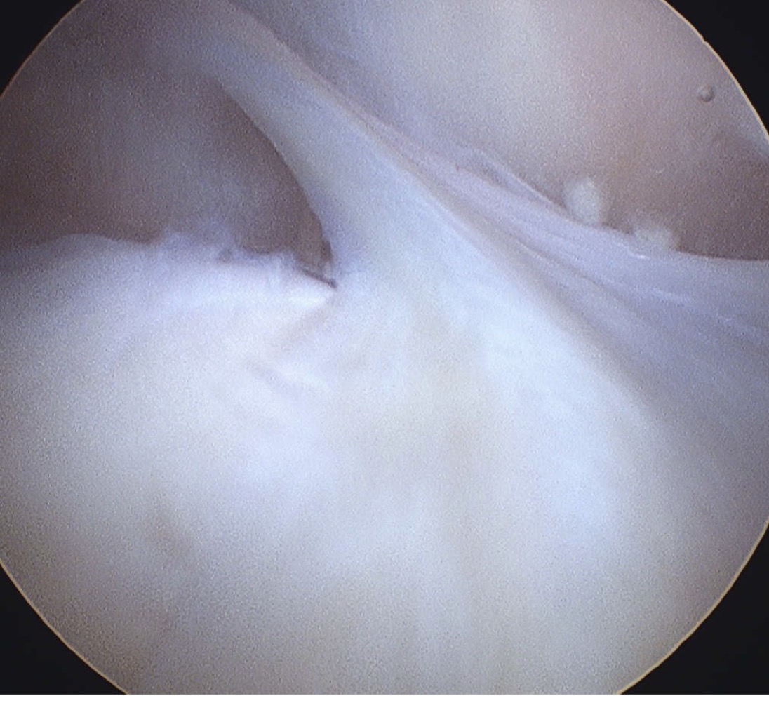 Arthroscopic view of a thickened medial plica