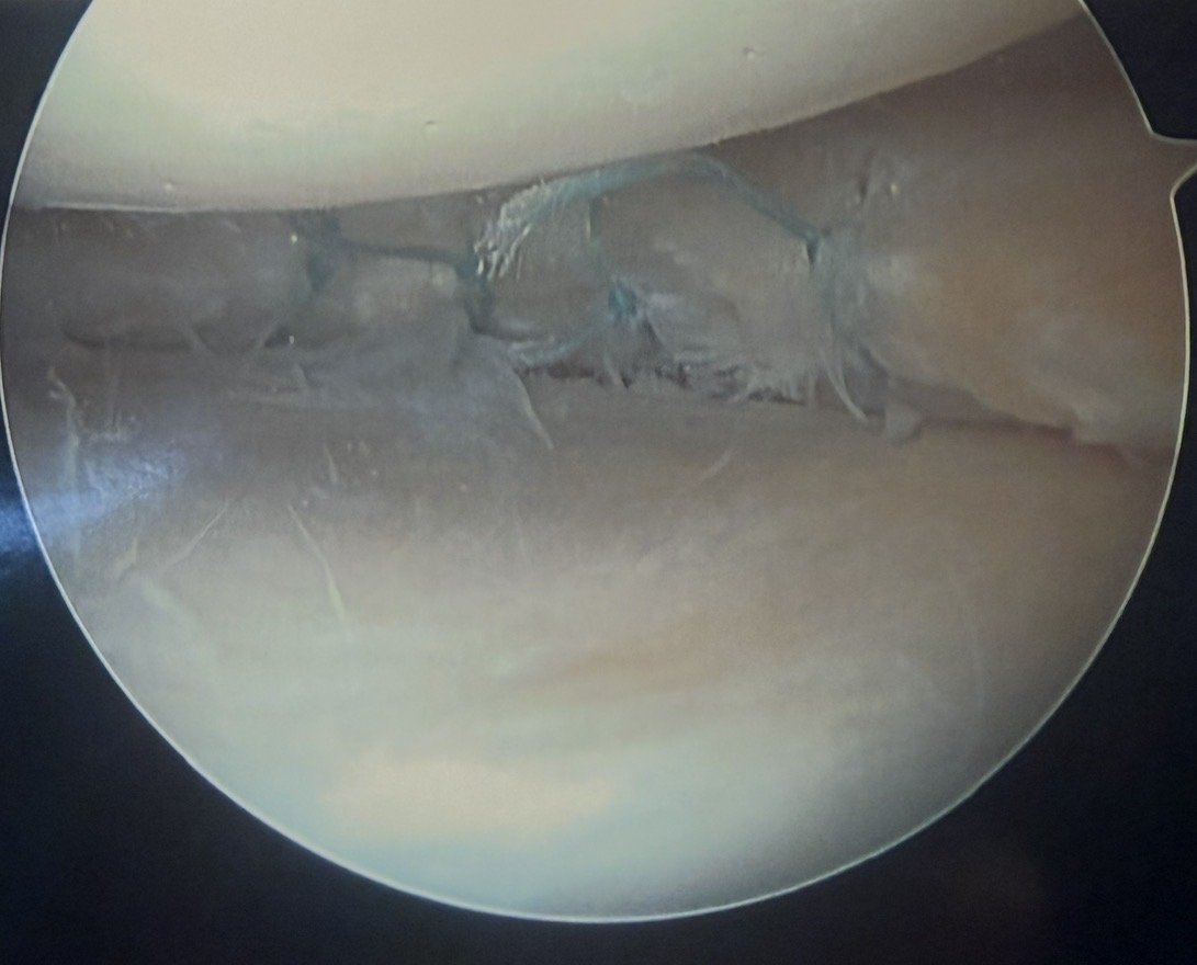 Arthroscopic view of a repaired meniscus with sutures
